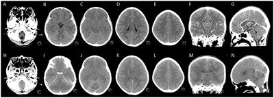 Case report: Distinct neurologic manifestation and cytokine profile of a child with COVID-19-associated acute fulminant encephalitis